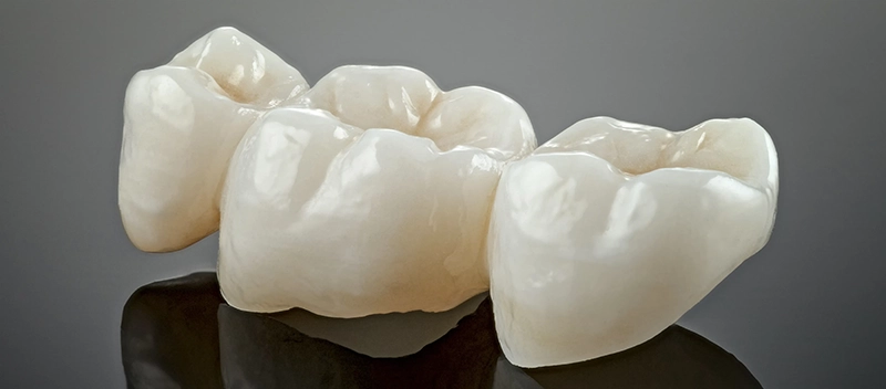 Dental bridge restoration close-up