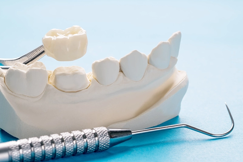 Dental Crowns in Wheaton, IL: A Patient’s Guide