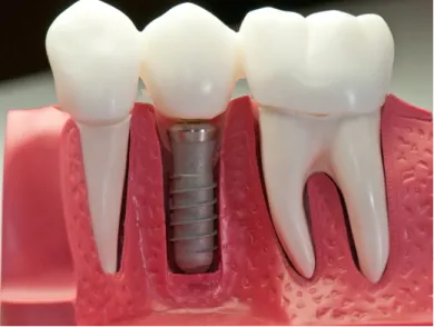 Implant Dentistry