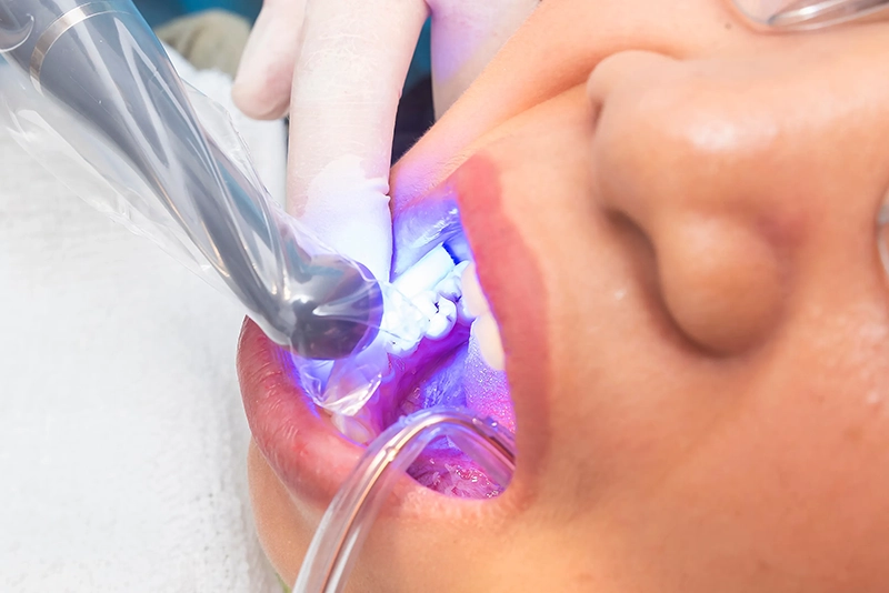 Dental Bonding in Wheaton, IL