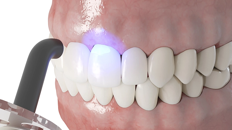 Dental bonding procedure