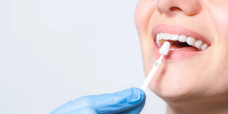 Porcelain dental veneers