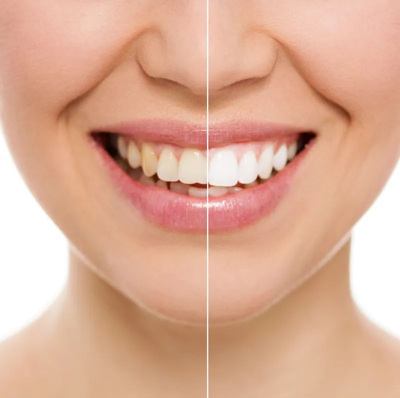 Teeth Whitening in Wheaton, IL: Clear Options for a Brighter Smile